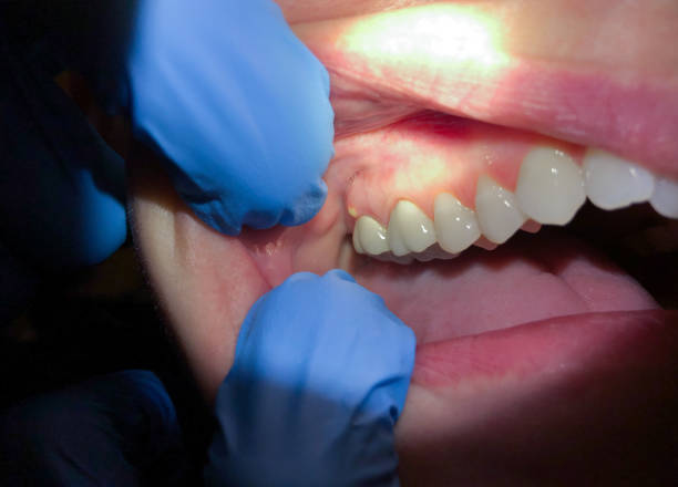Best Emergency Wisdom Teeth Removal in Ligh, NE